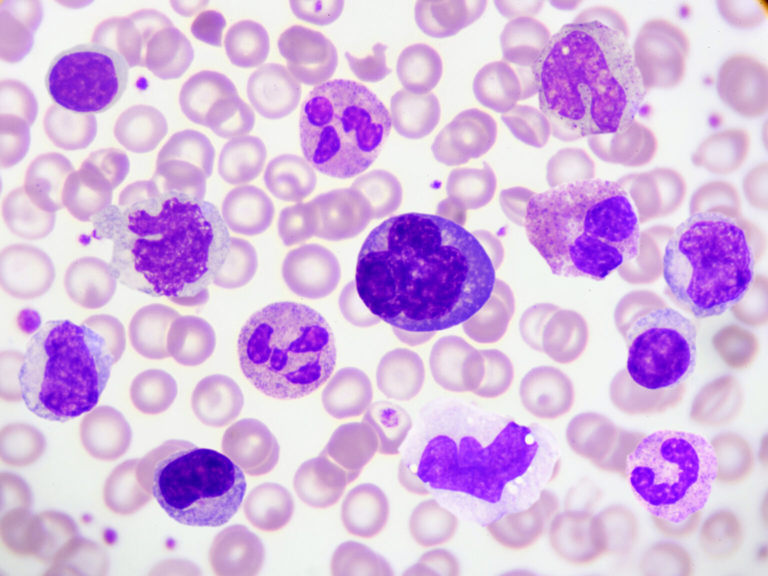 Sebastien Rinaldetti New LIH publication in Leukemia: understanding treatment-free remission ...